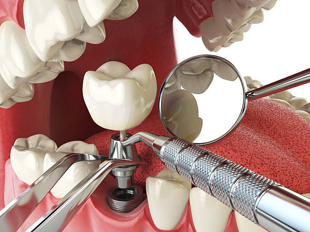 Best Emergency Root Canal Treatment in Johnson City, KS